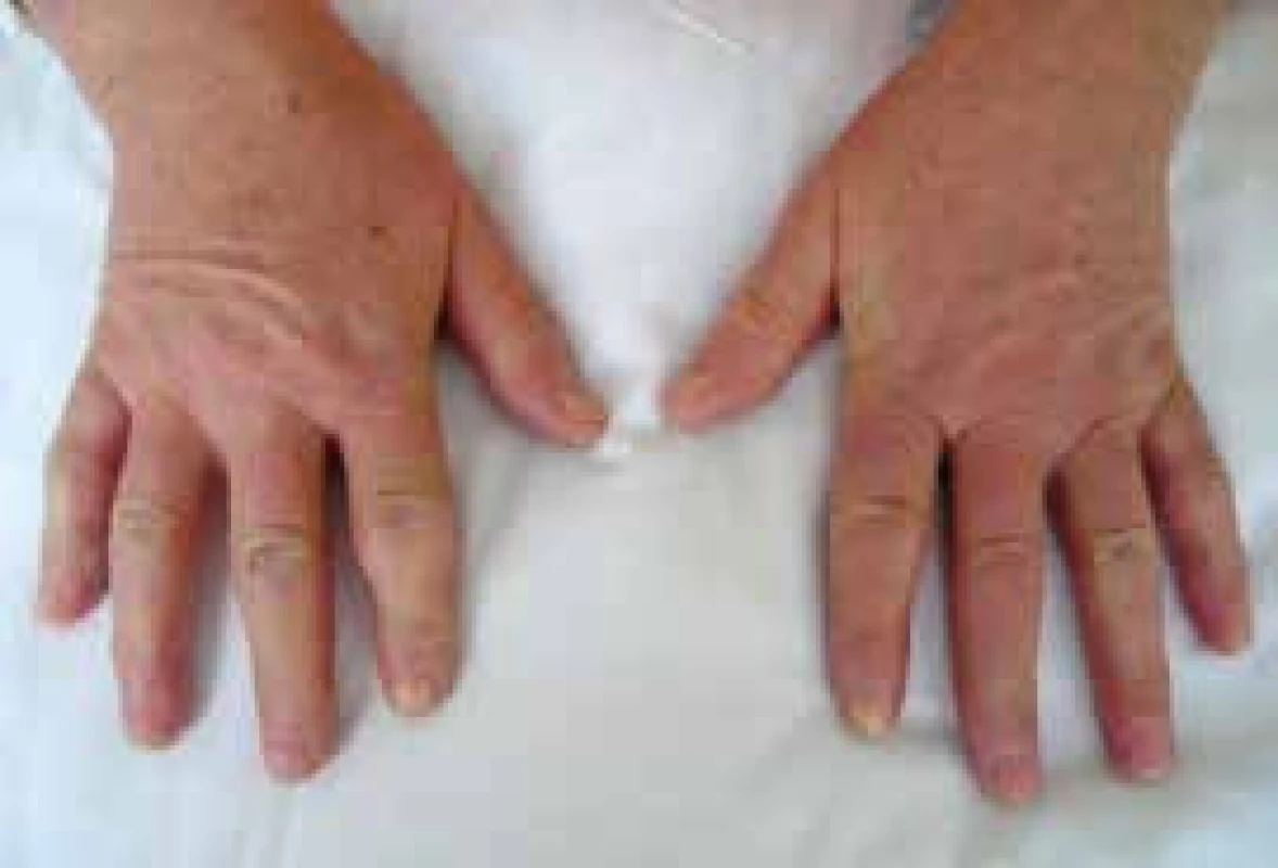 Sklerodermické postižení prstů ruky (sklerodaktylie) u nemocné se systémovou sklerodermií. Změny kůže jsou také patrny na dorzu rukou. Archiv autora