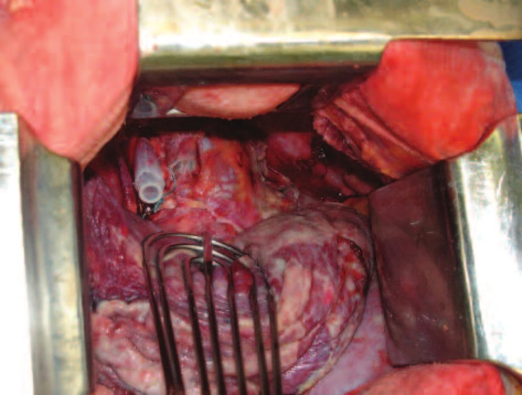 Proplachový drén protažený cervikálním přístupem pretracheálně pleurálně vpravo
Fig. 4: A lavage drainage is installed through the cervical approach to the pretracheal right  pleural space
