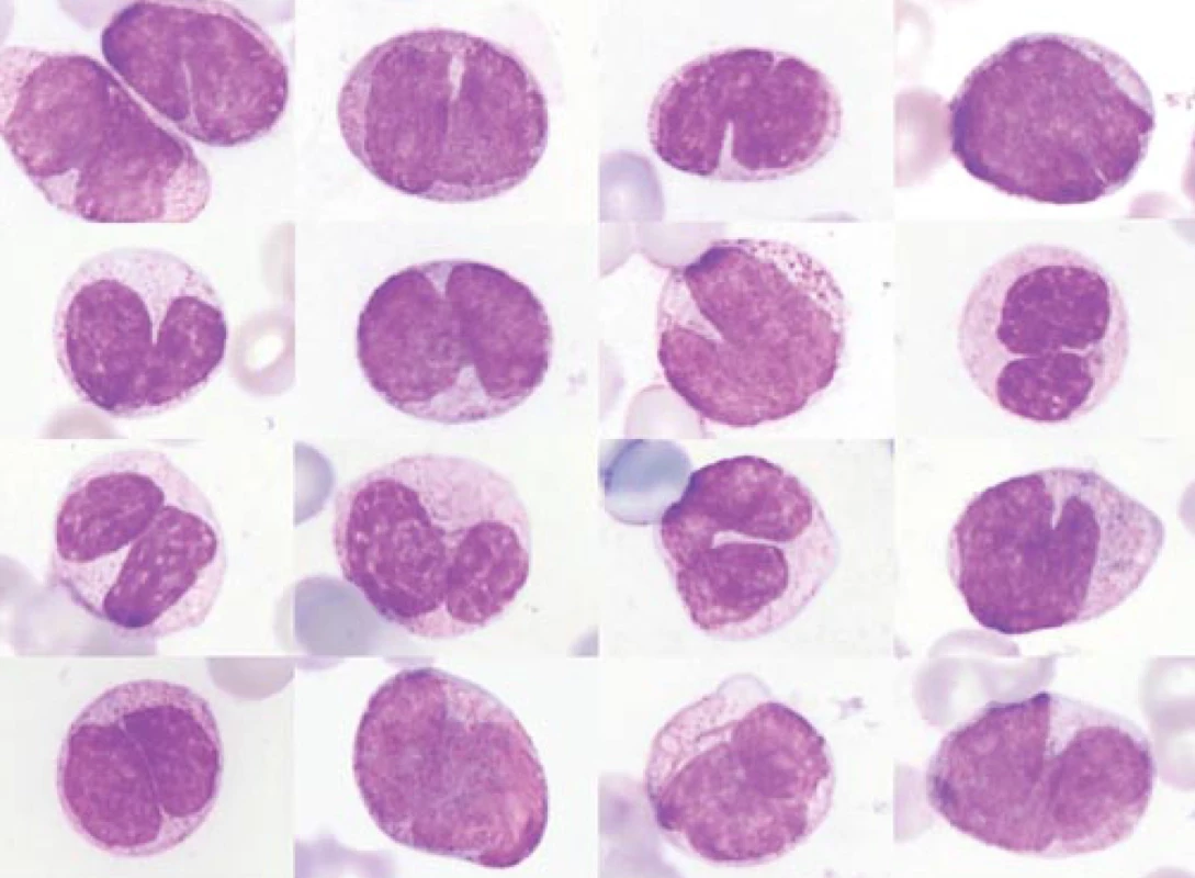 Různé typy ATRA buněk. Jde o buňky vyplavované in vivo do periferní krve pacientky léčené monoterapií ATRA. Buňky se nacházejí v různém stadiu maturace, žádná z nich se však nepodobá fyziologicky se vyskytujícím buňkám při diferenciaci a maturaci normálních neutrofilů. Vyobrazené buňky jeví extrémní maturační asynchronii v podobném smyslu jako in vitro diferencující buňky na obr. 3. V souladu s tím je také patrný nefyziologický typ dělení jader: počíná malým zářezem v jaderné membráně, pak se jádro rozdělí napříč.