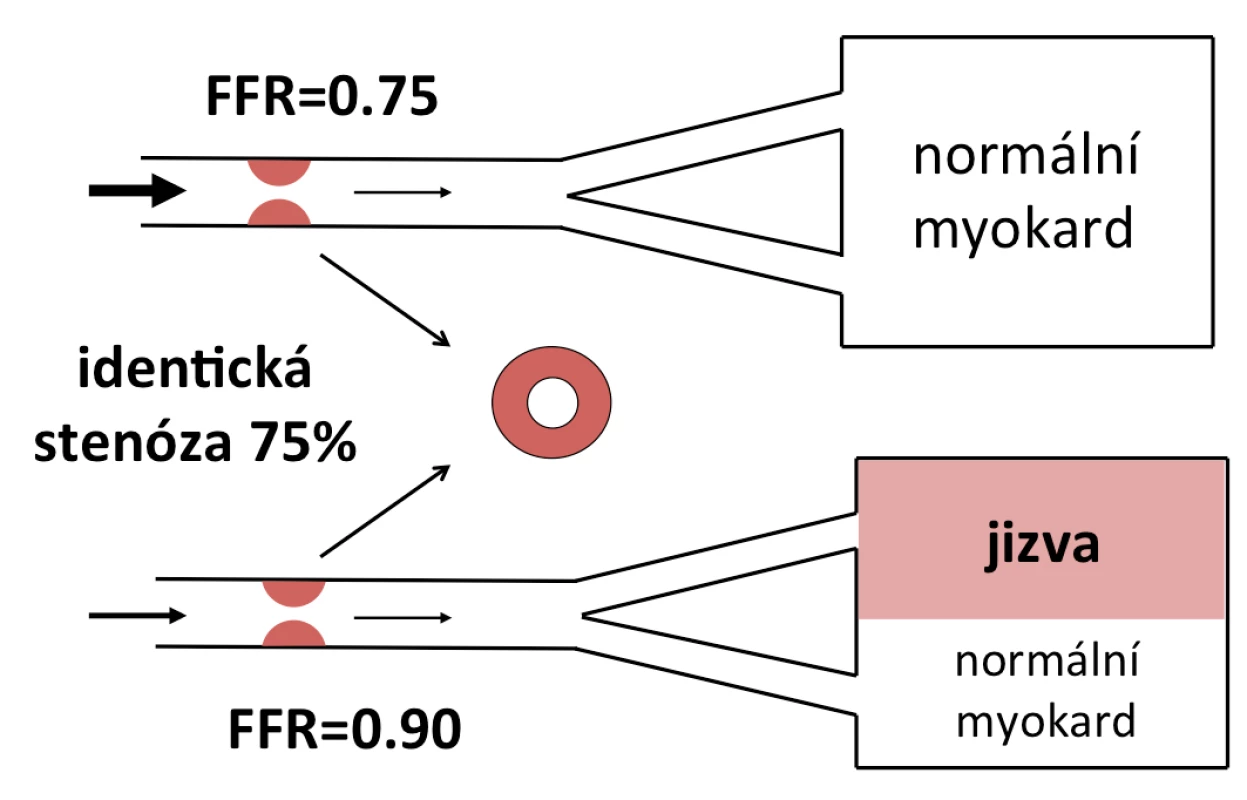 Diskrepance mezi morfologickým nálezem a funkčním dopadem. FFR zohledňuje masu viabilního myokardu, který je postiženou tepnou zásobován (upraveno dle: Pijls, Sels, 2012).