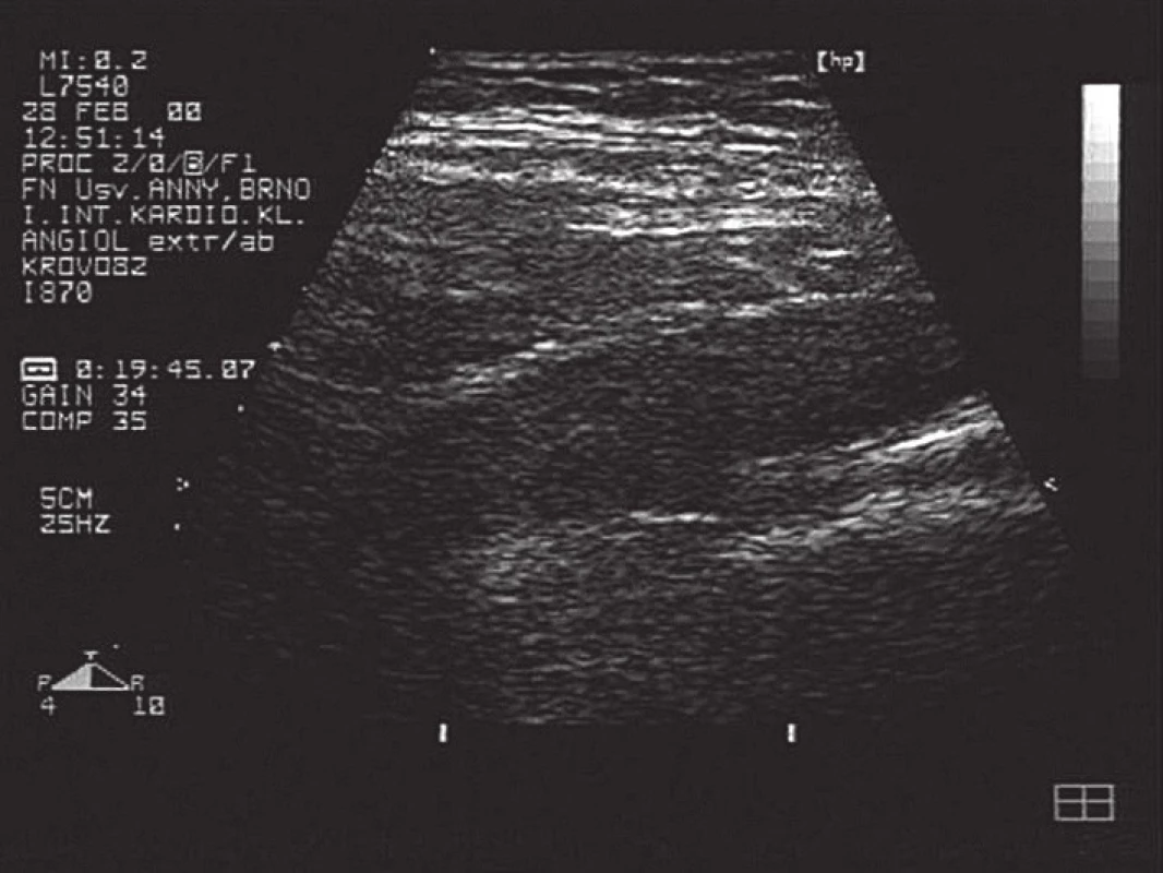 Cévka v podklíčkové žíle, zachycená ultrazvukem.