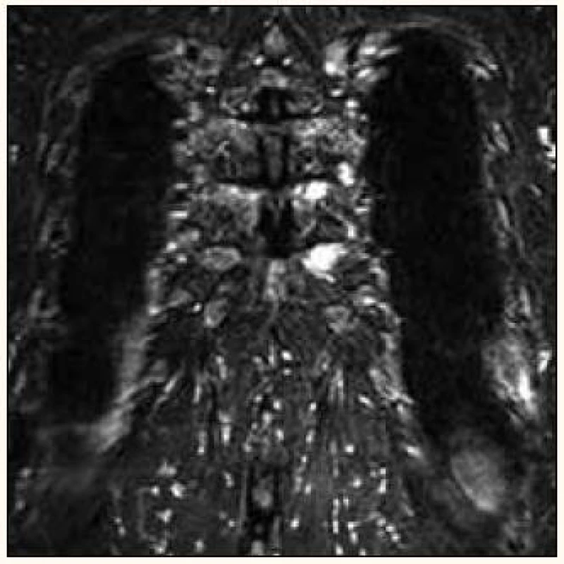 MR snímek prokazuje myelomová ložiska dvou mediálních konců žeber vlevo (stejný nemocný jako na obr. 6).