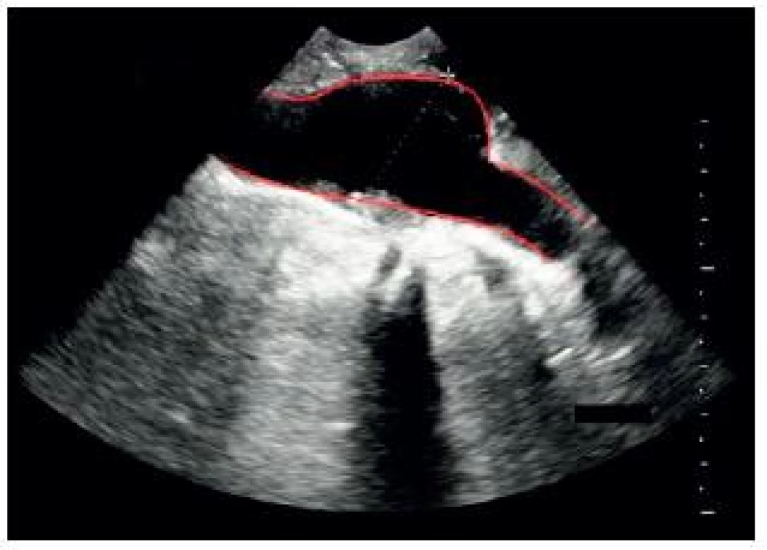 Podélné (longitudinální) zobrazení vakovitého aneurysmatu břišní aorty