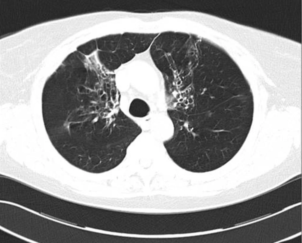 HRCT hrudníku nemocné s bronchiektáziemi při alergické bronchopulmonální aspergilóze