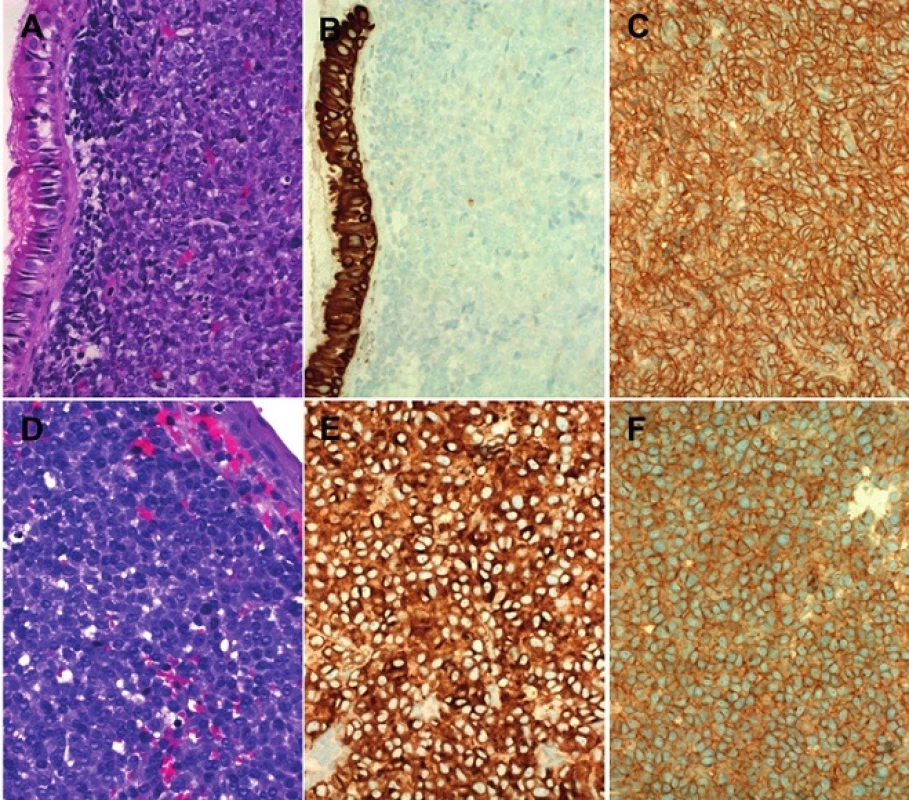 This example of conventional sinonasal Ewing sarcoma (A) lacked any specific line of differentiation (B, pan-CK) and strongly expressed CD99 in membranous pattern (C). This case was confirmed by EWSR1-FISH. Small cell variant of sinonasal amelanotic melanoma growing beneath metaplastic surface epithelium (D) with strong expression of pan-melanoma cocktail (E) and moderate membranous expression of CD99 which could be mistaken for Ewing sarcoma (F).