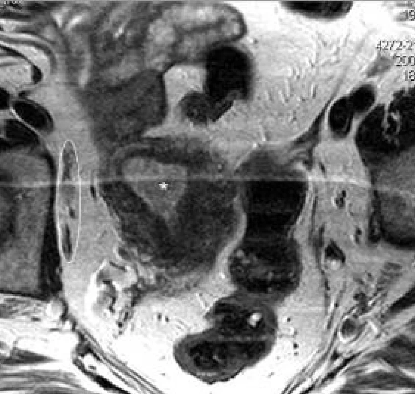 Karcinom těla děložního, endometria. Vpravo v oválu skupina patologických lymfatických uzlin zevních ilických. Pruh přes snímek je artefaktem obrazu vlivem dýchacích pohybů.