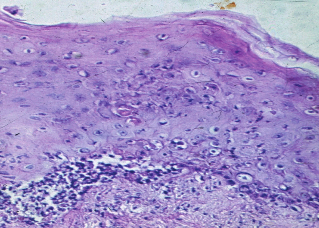 Rejekce epidermis u alogenního dermoepidermálního štěpu excidovaného po 14 dnech po transplantaci
&lt;i&gt;Foto: MUDr. Z. Kerekes, CSc.&lt;/i&gt;