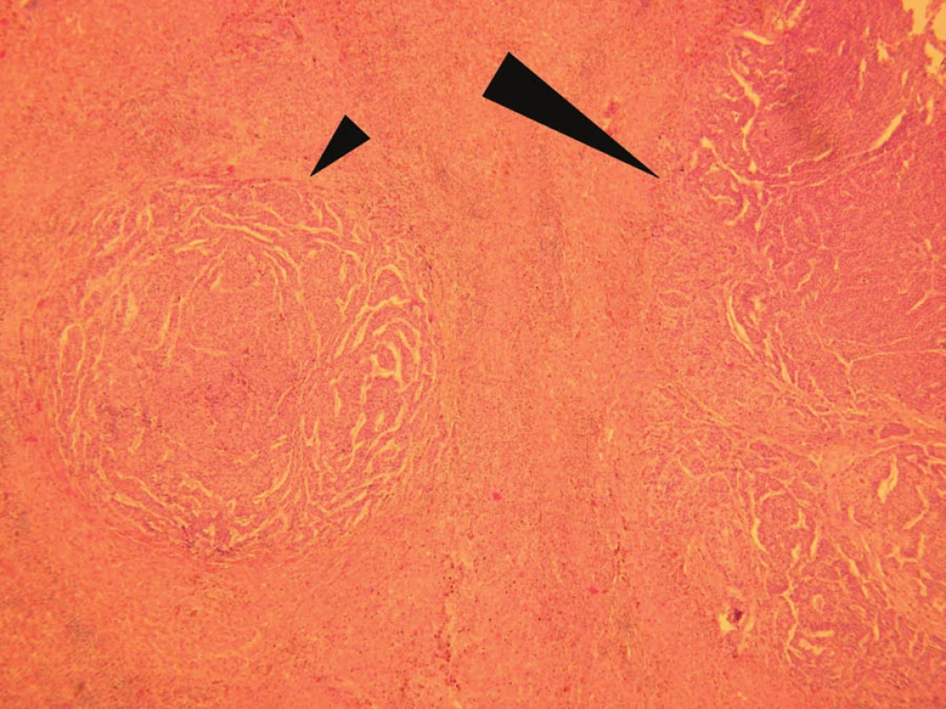 Histologické vyšetření: jaterní metastáza adenokarcinomu žaludku (velká šipka) s dceřiným ložiskem charakteru mikrometastázy v jeho těsné blízkosti (malá šipka). Barvení hematoxylin-eosin, zvětšení 100x
Fig. 5: Histopathological investigation: liver metastasis form gastric cancer (large arrow) with satellite micrometastasis in its close proximity (small arrow). Hematoxylin-eosin staining, magnified 100x