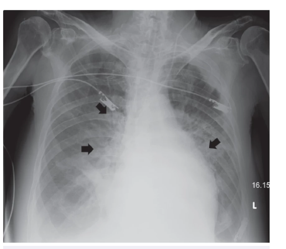 RTG snímek plic
Na snímku vleže snížená transparence v obou křídlech s výrazně chudou kresbou a výpotkem v interlobiu vpravo, ztluštělá pleura vlevo v horním plicním poli, srdce bez výraznější dilatace, skleróza aorty. Centrální žilní katétr zavedený přes v. subclavia l. sin,. končí ve v. jugularis. Závěr: V. s. fluidothorax, bilaterální suspektní infiltráty parahilosně či počínající plicní edém (znázorněno šipkami), ztluštělá pleura vlevo.
Fig. 1. Chest X-ray
The soupine X ray shows reduced transparency in both lungs with poor visualisation and right interlobar effusion, thickened pleura in the left upper lobe, no evidence of cardiac dilatation, and aortic sclerosis. Central venous catheter inserted through the left subclavian vein to the jugular vein. Conclusion: probably pleural effusion, suspected bilateral parahilar infiltrates or early pulmonary oedema (indicated by arrows), and left-sided pleural thickening.