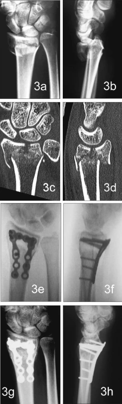 Zlomenina distálního radia typu C.2. (a, b, c, d), osteosyntéza rámovou dlahou systému Aptus radius (e, f), kostní hojení po 8 týdnech (g, h)
Fig. 3. The distal radius fracture, type C.2. (a, b, c, d), osteosynthesis with the Aptus radius frame plate (e, f), the bone healing at 8 weeks (g, h)