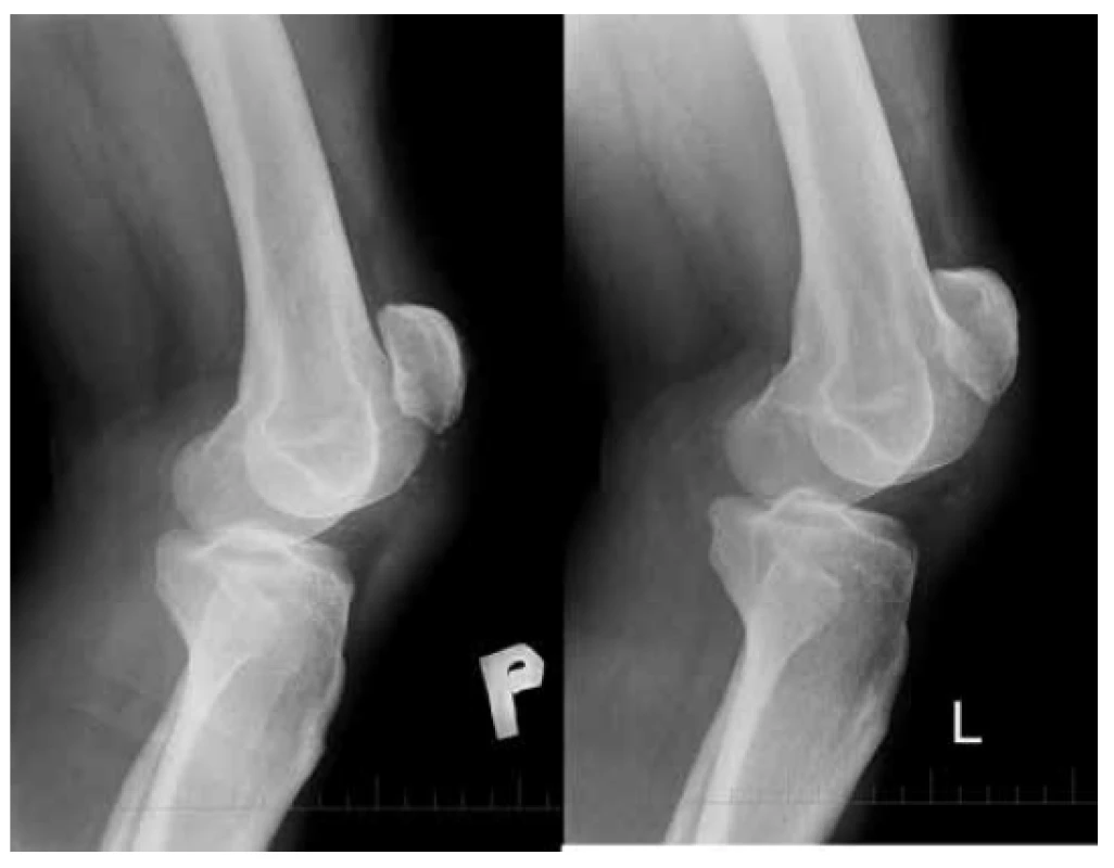 <i>Patella alta</i> (Insall-Salvati ratio= 1,84)
Bočná projekcia obidvoch kolien po úraze.<br>
  Fig. 1: <i>Patella alta</i> (Insall-Salvati ratio= 1.84)
Lateral view of both knees after injury.