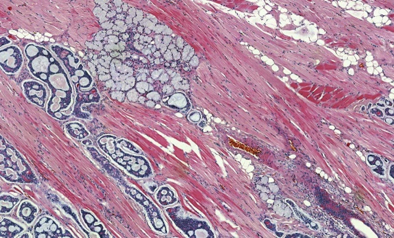 Adenoidně cystický karcinom s typickou kribriformní strukturou a invazivním růstem (hematoxylin-eozin).
