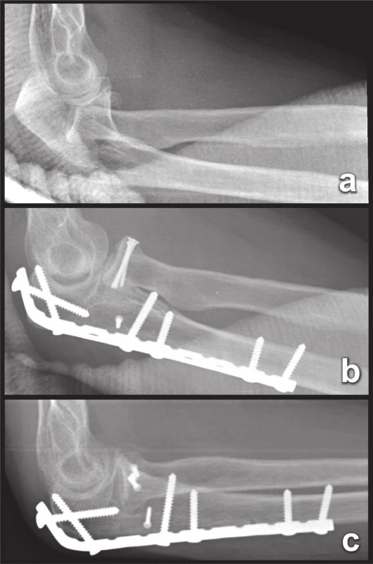 Osteosyntéza zlomeniny z obr. 12. a – žena, 38 r., luxační zlomenina proximálního předloktí Monteggiova typu (částečná zlomenina a zadní luxace hlavice radia a intraartikulární zlomenina proximální ulny), b – stav po operaci, c – stav 3 měsíce po operaci, anatomické zhojení zlomeniny.
Fig. 18: Internal fixation of fracture from Fig. 12. a – a woman, 38 y, fracture-dislocation of the proximal forearm of the Monteggia type (partial fracture and posterior dislocation of the radial head and intra-articular fracture of the proximal ulna), b – immediately postoperatively, c – 3 months postoperatively, healing in anatomical position.