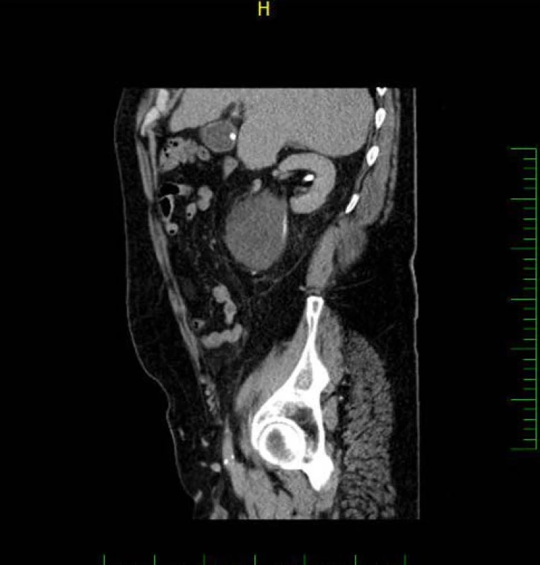 CT, sagitální řez, vylučovací fáze: pravý močovod bez zjevného útlaku probíhající dorzálně od tumoru, v žlučníku patrná cholecystolitiáza
Fig. 3. CT scan, sagittal section, excretory phase: a right ureter with no obvious compression running dorsally to the tumour, a cholecystolithiasis in the gallbladder is apparent