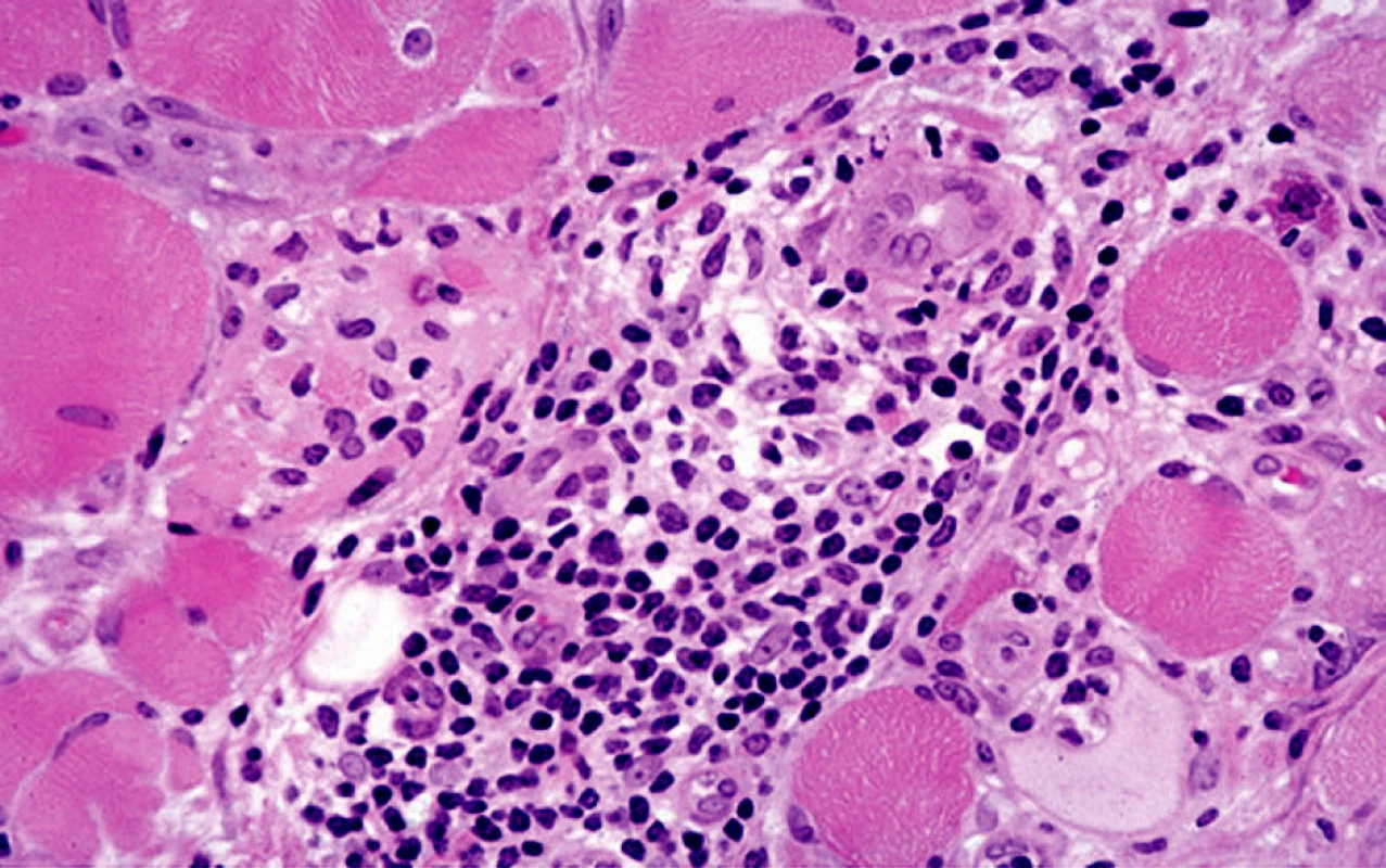 Histologický obraz dermatomyozitidy