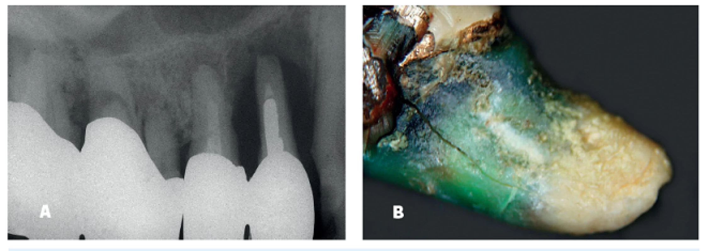 RTG snímek zubu 24 (a), stav kořene po expozici 10 let (b)