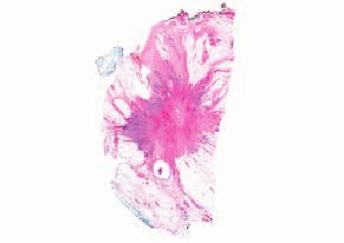 Histotopogram karcinomu prsu.
Cípaté okraje tumoru jsou zbarvené fialově.