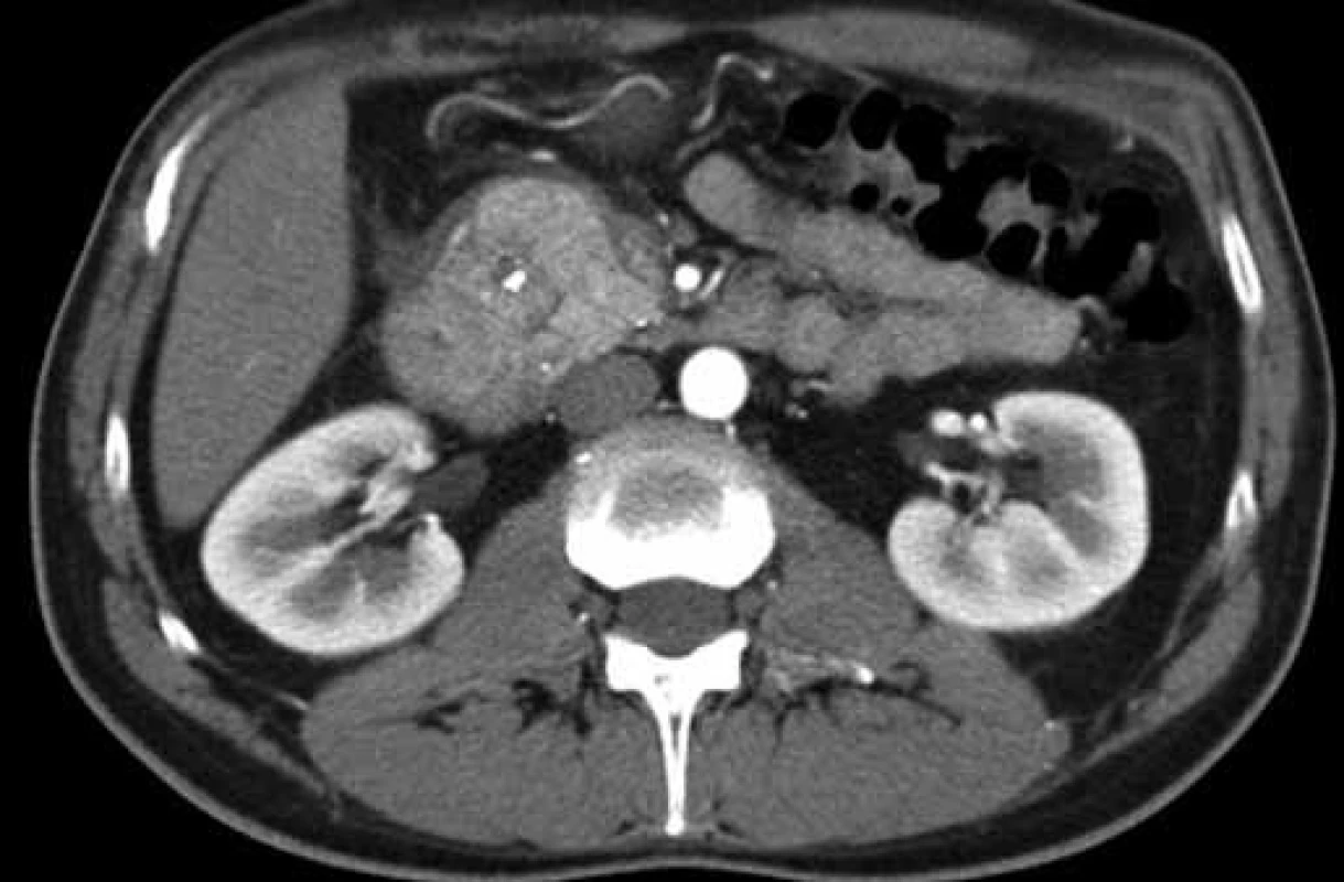 CT finding of a focally changed pancreatic head in the ‚groove‘ region and the adjacent duodenal wall (patient 1).
Obr. 2. CT obraz fokálne zmenenej hlavy pankreasu v oblasti „žliabku“ a priľahlej stene duodéna (pacient č. 1).