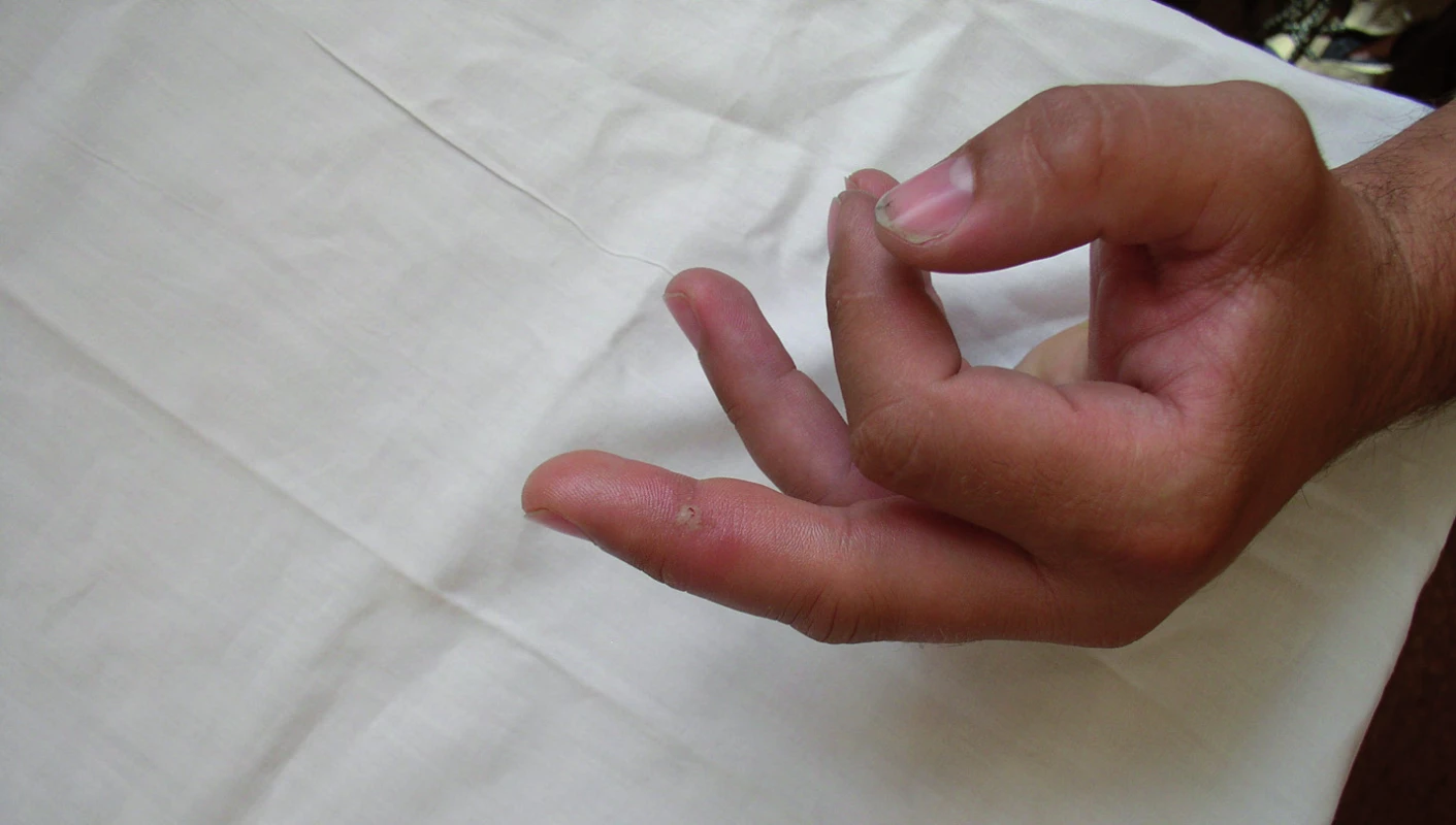 Erytematozní otok a vesikula na III. prstu levé ruky po poranění ostnatcem (archív KICH FN Brno)