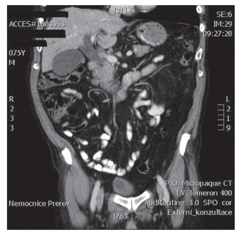 Kazuistika 2, CT pankreatu – dilatace žlučových cest bez zjevného tumoru
Fig. 1: Case 2, CT of the pancreas – dilated bile ducts; no signs of the tumor