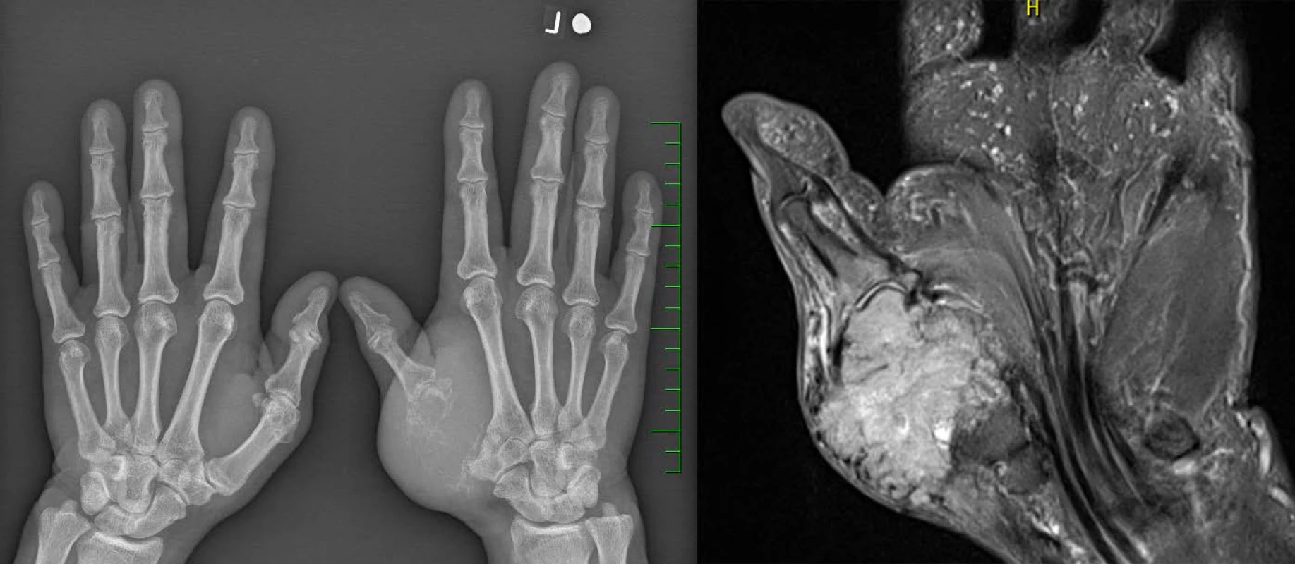 Rtg (vlevo) a MRI (vpravo): metastáza světlobuněčného renálního karcinomu v záprstní kosti palce levé ruky
Fig. 1. X-ray (left) and MRI (right): the metastasis of a clear cell renal cell carcinoma in the left thumb