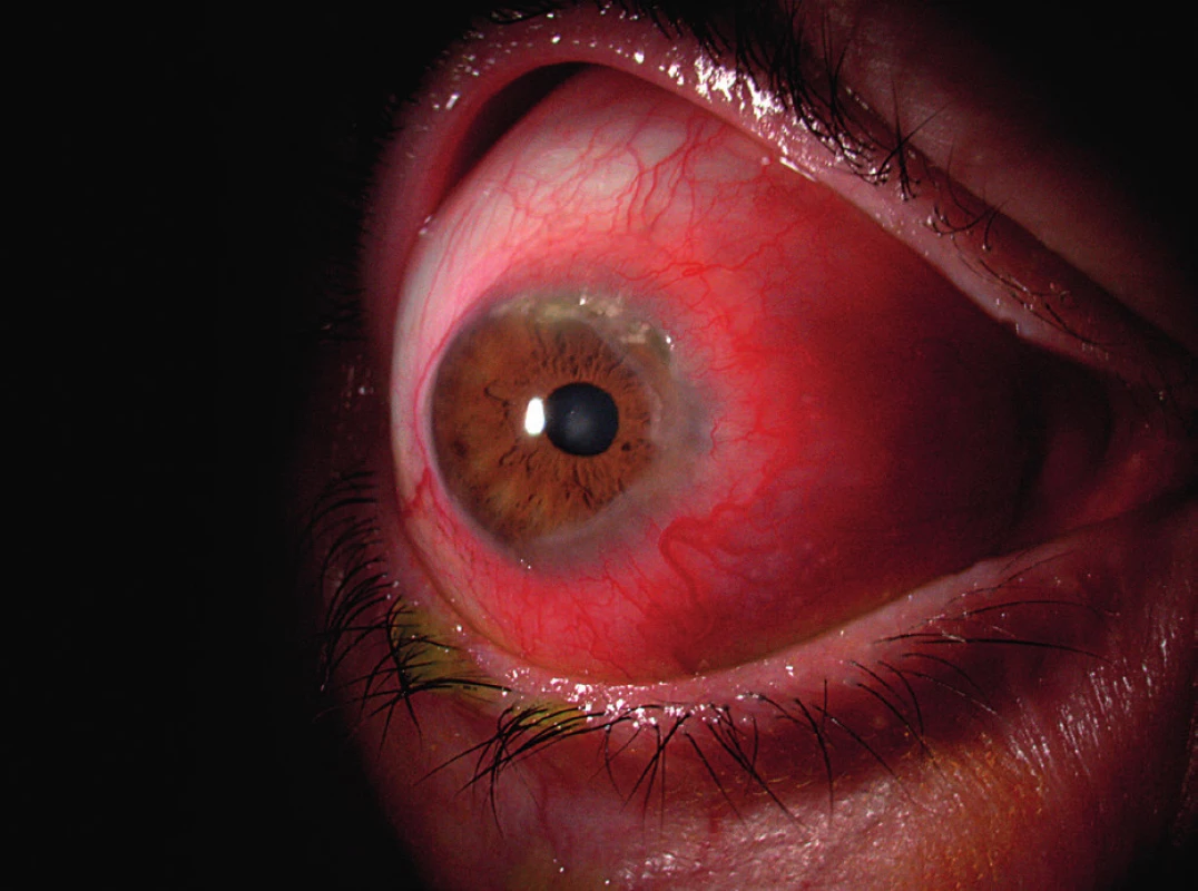 Sklerokeratitida v rámci postižení oka periferní ulcerózní keratitidou.