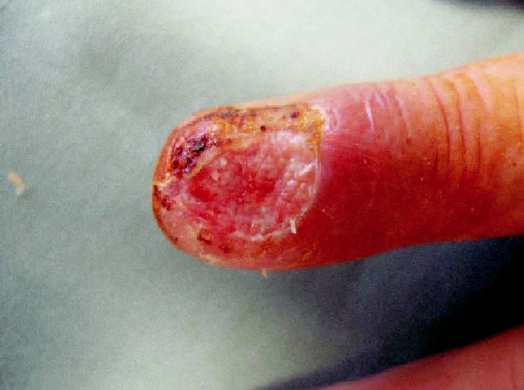Subunguální spinocelulární karcinom – stav po ablaci nehtu
Fig. 1. Subungual spinocellular carcinoma – after nail ablation