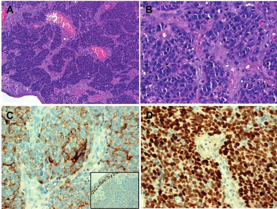 Several sinonasal neoplasms remain unclassified such as this poorly differentiated small cell non-neuroendocrine carcinoma (A) which developed years after irradiation for uveal melanoma. Nested pattern may mimic high-grade esthesioneuroblastoma (B). Pancytokeratin showed diffuse perinuclear pattern with focal abortive gland-like/rosette-like accentuation (C, main image). P63 was negative in the tumor cells (C, inset). D: almost all of tumor cells expressed TP53 suggesting TP53 mutation.
