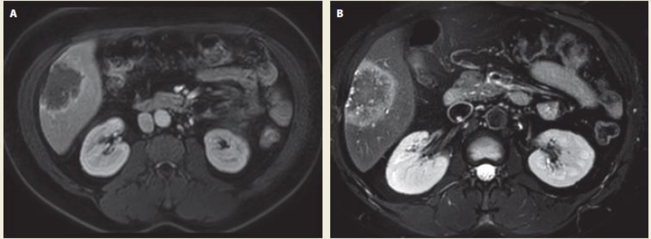 Echinococcal liver lesion on MRI – A. T1 weighted image in portal phase of contrast enhancement – axial scan;
B. T1 weighted image – axial scan. In the right liver lobe in the 5th segment there is a post-contrast T1 hypointense hypovascular
focal lesion with hyperintense margin of hyperperfusion, the centre of the lesion remains unenhanced (A). On the
T1 weighted image the lesion is hypointense, on the margin we can see small hyperintense areas – small cystic formations (B).
Source: Department of Radiology, Hospital Kyjov.<br>
Obr. 1. Echinokokové postižení jater na MR – A. T1 vážená sekvence po podání kontrastní látky v portální fázi v axiální rovině;
B. T1 vážená sekvence v axiální rovině. V pravém laloku jater v 5. segmentu je postkontrastně v portální fázi T1 hypointenzní
hypovaskularizované ložisko s hypervaskularizovaným hyperintenzním lemem (A). Na T1 je léze hypointenzní, po obvodu patrny
drobné hyperintenzní okrsky v rámci drobných cystických kolekcí (B). Zdroj: Radiologické oddělení, nemocnice Kyjov.