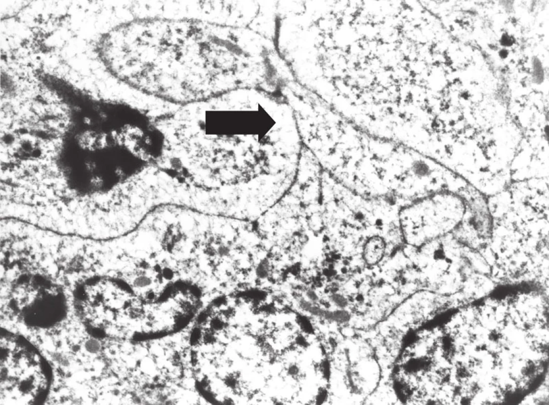 Elektron- mikroskopický obraz buněk sarkomu z dendritických interdigitujících buněk, s širokými interdigitujícími cytoplazmatickými výběžky (šipka).