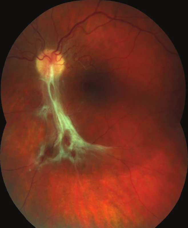 Barevný fotografický snímek fundu levého oka: preretinální fibróza při dolní temporální arkádě způsobující nařasení sítnice v centrální krajině