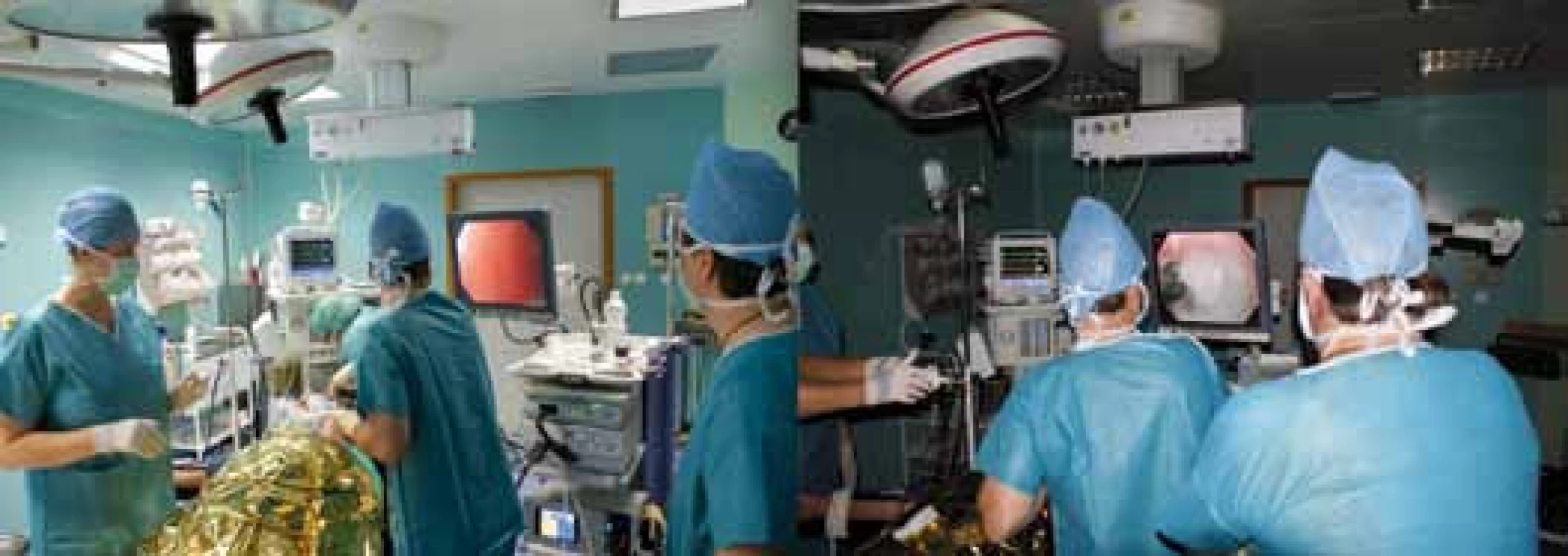 A – Začiatok POEM u prvého pacienta, vľavo endoskopická sestra Barbora Malá z iKEM, v strede doc. Martínek pri zavádzaní endoskopu, vpravo dr. Ušák. B – iniciácia slizničnej incízie v pažeráku po predchádzajúcej submukóznej aplikácií metylénovej modrej, v strede doc. Martínek, vpravo dr. Ušák.
