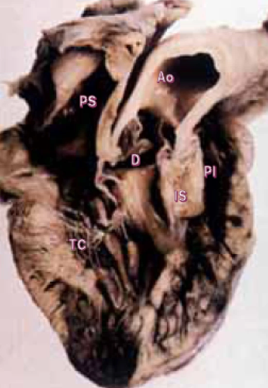 Fallotova tetralogie v pohledu z pravé komory. Vidíme aortu nasedající na defekt komorového septa, a deviaci infundibulárního septa dopředu, působící stenózu plicnice. 