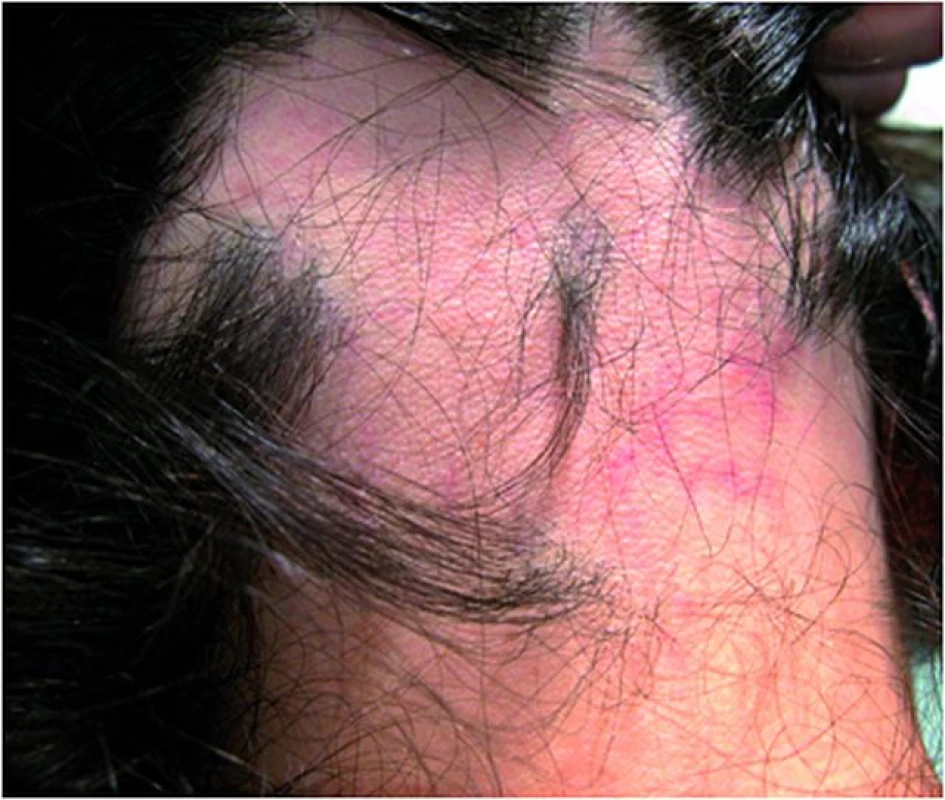 Alopecia areata před léčbou