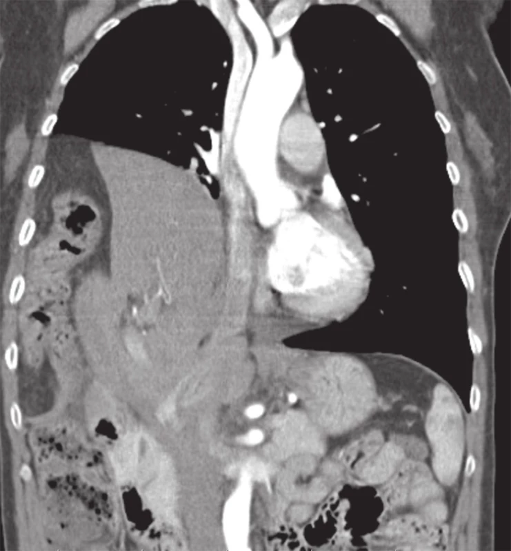 CT nález pravostranné ruptury bránice
Fig. 4: CT finding of right-sided diaphragmatic rupture