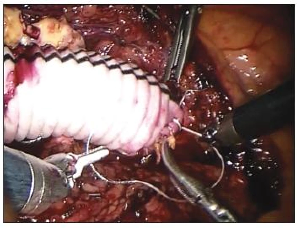 Centrální anastomóza výdutě břišní aorty
Fig. 8. Central anastomosis of the abdominal aortic aneurysm
