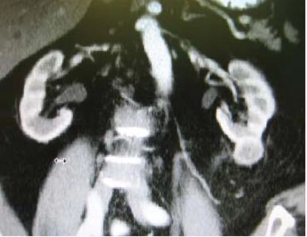 Tumor dolního pólu levé ledviny indikovaný k LRL.