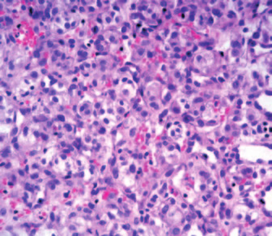 Biopsie – světlobuněčný renální karcinom.
Fig. 2. Biopsy – clear cell renal carcinoma.