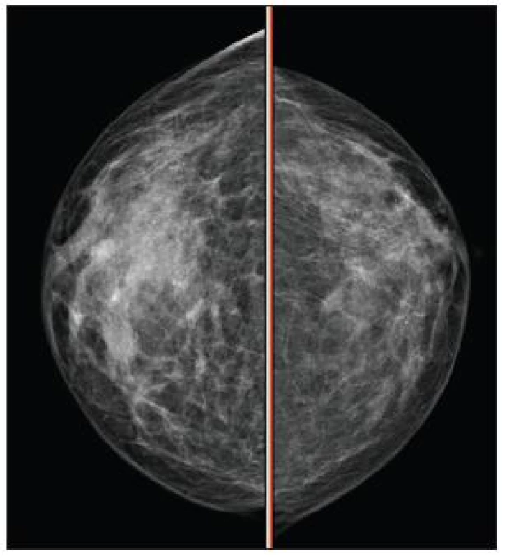 Mamografie pravého prsu
Fig. 10. Mamography of the right breast