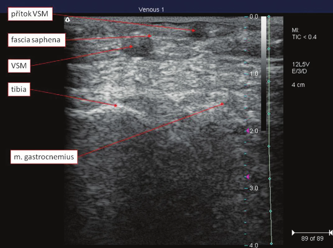 Topograficko-anatomické poměry VSM v oblasti kolene
Fig. 4. Topographic-anatomical relationships of VSM in the knee region