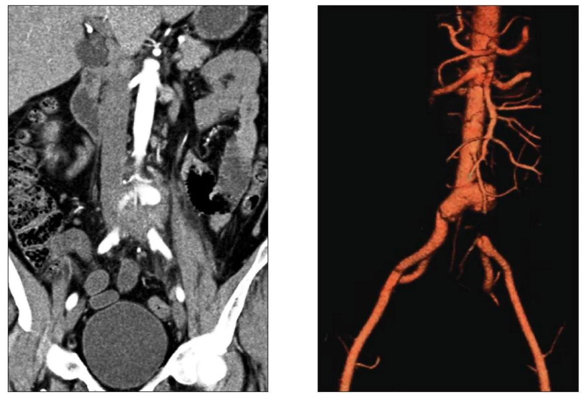Mykotické aneuryzma bifurkace aorty s přesahem na a. iliaca comm. l. sin. a s jejím tromboembolickým uzávěrem
Fig. 2. Mycotic aneurysm of the aortic bifurcation extending to the left common iliac artery with its thromboembolic occlusion