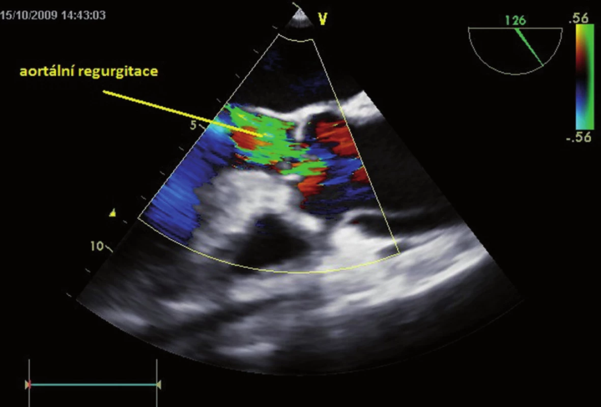 Sekundární významná aortální regurgitace při akutní disekci ascendentní aorty