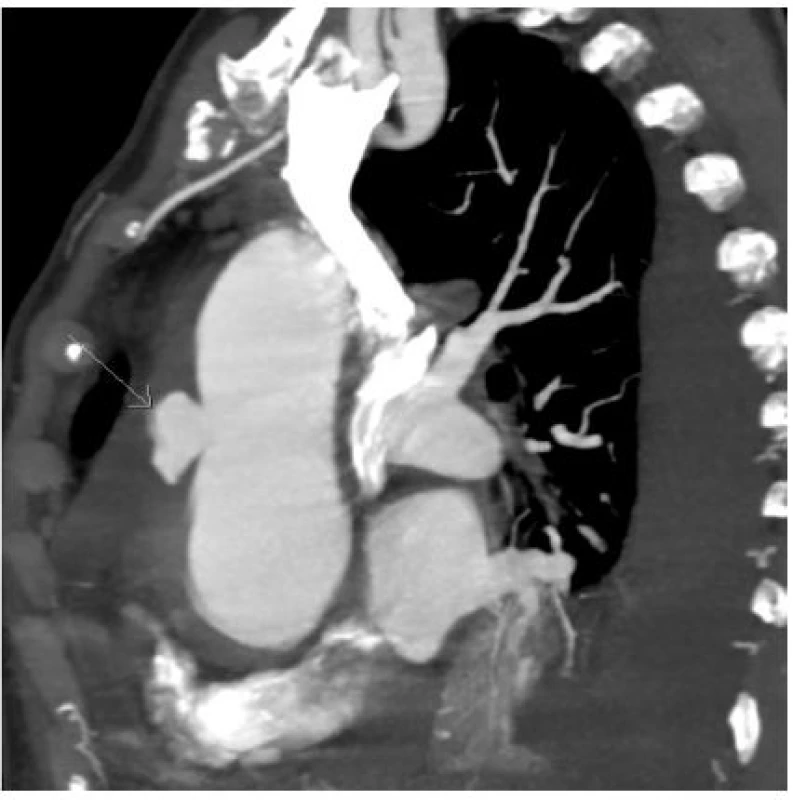 Dvojitá disekce ascendentní aorty na CT – sagitální rovina. Kaudálněji uložené disekující aneurysma při ventrální stěně vzestupné aorty (označené šipkou). V okolí méně denzní lem hematomu.