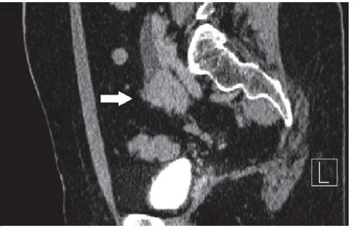 CT po podání kontrastní látky intravenózně – šipka ukazuje na tumor močovodu
Fig. 1. CT after administration of intravenous contrast material – the arrow points to the tumor ureter