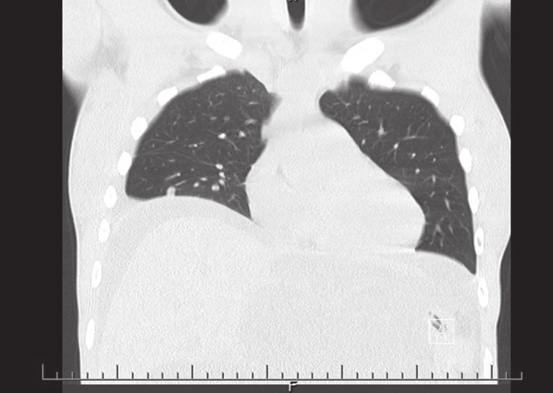 CT hrudníku 23. 5. 2014
Fig. 2: Chest CT scan 23. 5. 2014