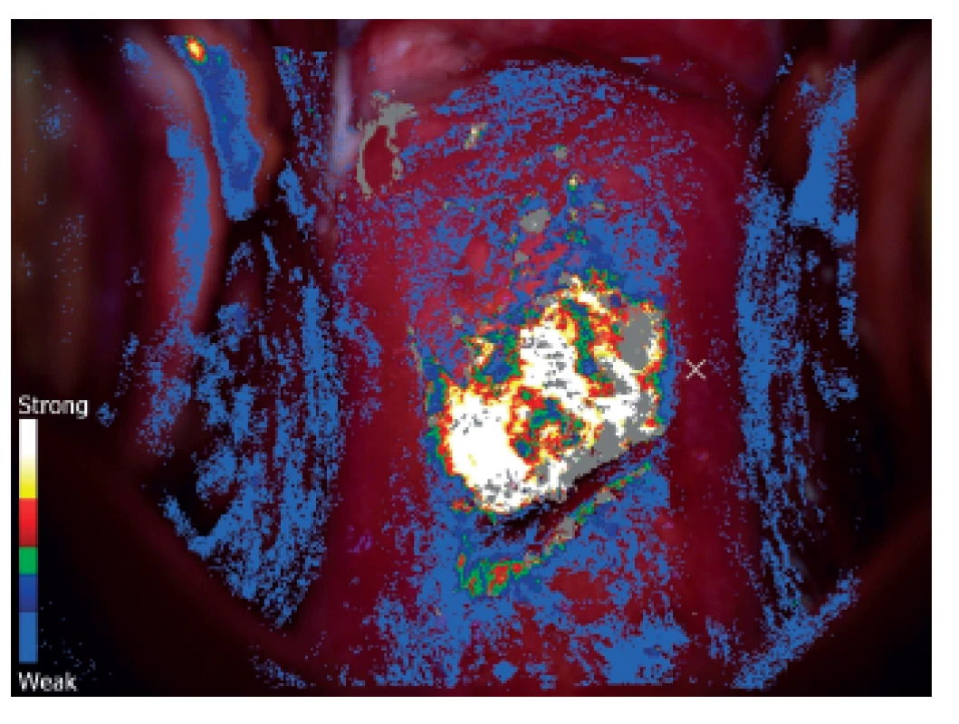 Počítačová analýza obrazu u pacientky z obrázku č. 1 systémem DySIS. V místech s bílou, žlutou a červenou barvou je nejrychlejší nástup zbělení po aplikaci 5% kyseliny octové (zde se předpokládá HG léze a zde by měla být cílena klíšťková biopsie)