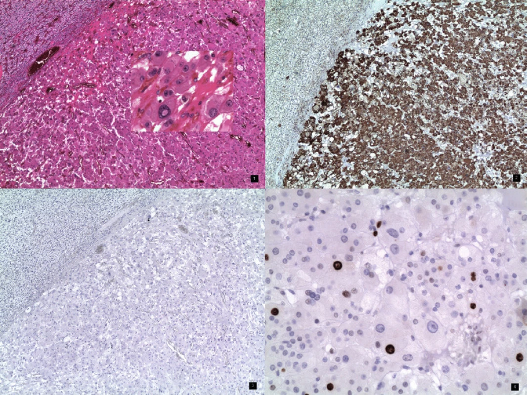 1. Onkocytom nadledviny s okrajem tlakově atrofické adrenální kůry. Barvení hematoxylin – eozin, obj. 4×. Vložený obrázek – onkocyty – detail, zvětšení 20×
2. Onkocytom nadledviny se silně pozitivním imunohistochemickým průkazem mitochondrií v cytoplazmě nádorových buněk. Slabě pozitivní je i nenádorová kůta nadledviny, obj. 4×
3. Onkocytom nadledviny s negativním imunohistochemickým průkazem chromograninu – neuroendokrinního markeru. Negativní je rovněž kůra nadledviny, obj. 4×
4. Onkocytom nadledviny – imunohistochemický průkaz proliferační aktivity – Ki-67 (MIB1). Jaderná pozitivita nádorových buněk ložiskově variabilní celkově 7%