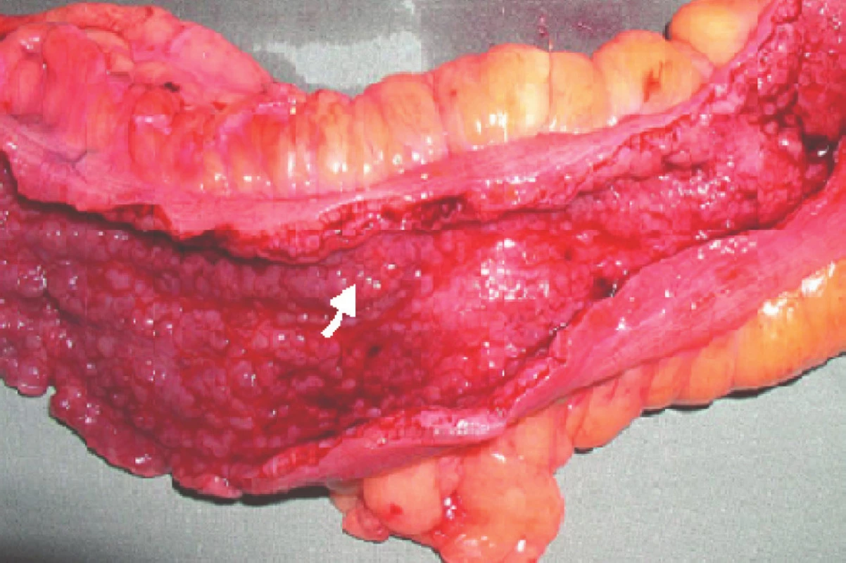 Karcinom sigmoidea v terénu UC – místo označeno šipkou
Fig. 1. Carcinoma of the sigmoid in a patient with ulcerative colitis – the site marked by an arrow
