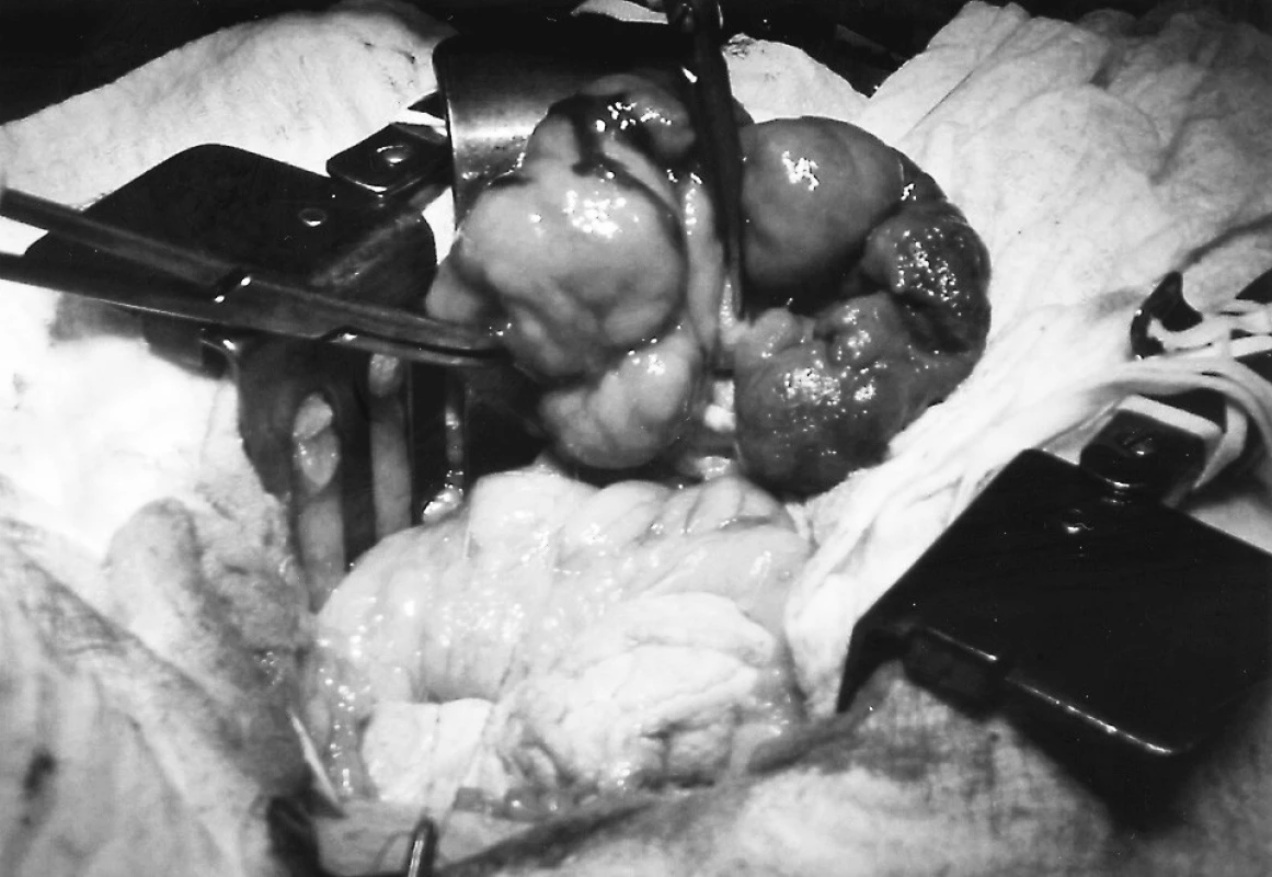 Tumor duodena peroperačně.
Pic. 3. The duodenal tumour during the operation