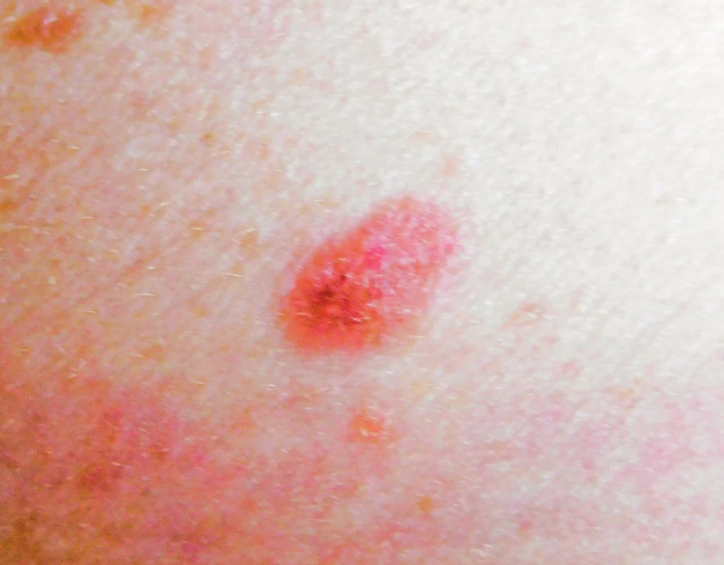 Incipientní, povrchově se šířící melanom &lt;i&gt;in situ&lt;/i&gt;